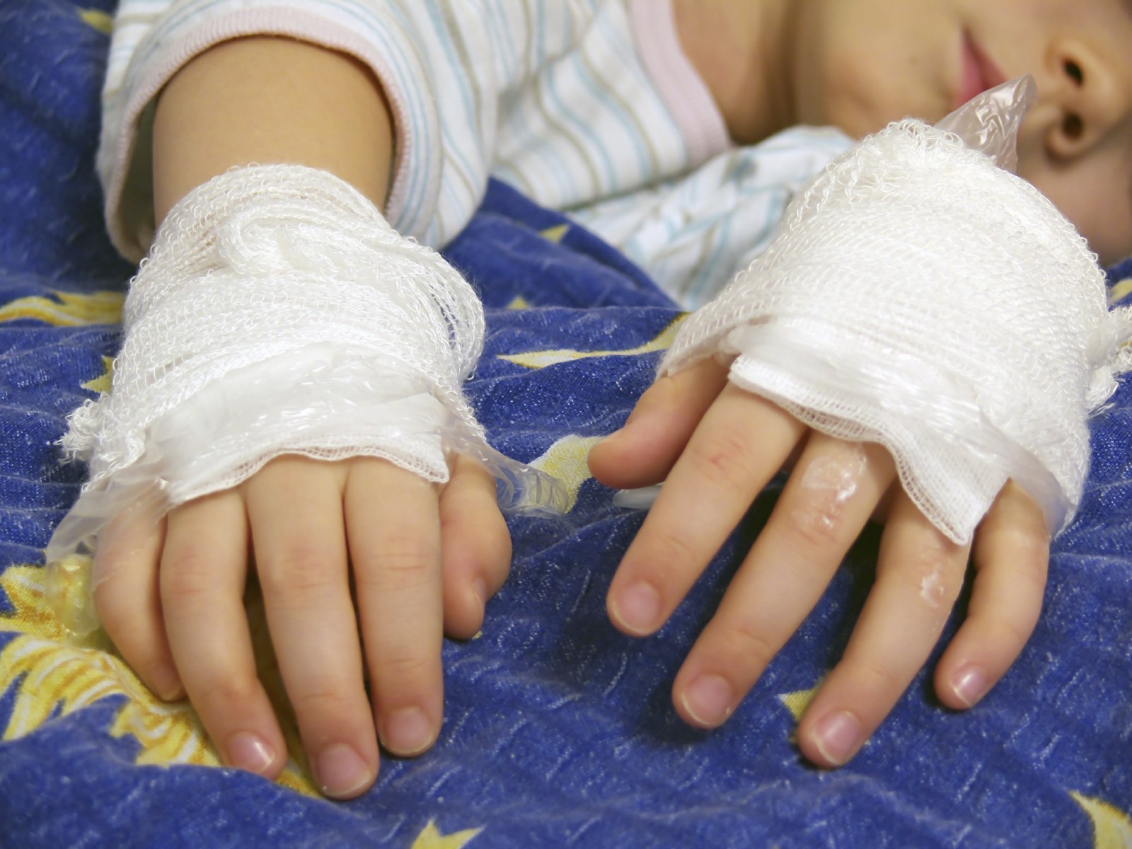 What to do if your child gets burnt